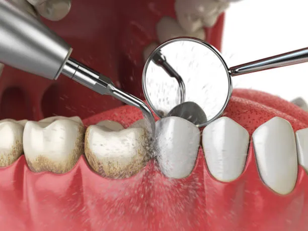 The benefits of regular dental cleanings