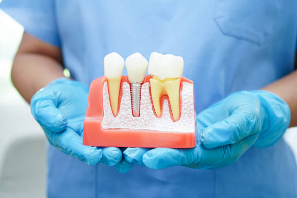 Understanding different types of dental implants