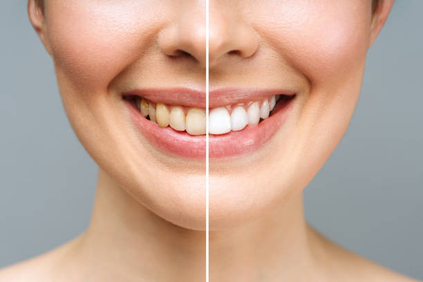 Teeth whitening: Professional vs. at-home treatments